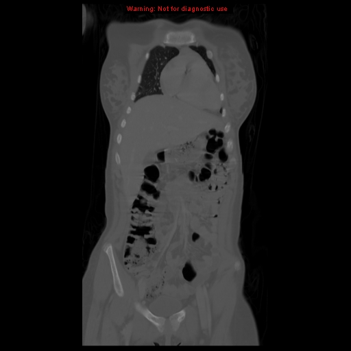File:Brown tumor (Radiopaedia 12318-12596 D 22).jpg