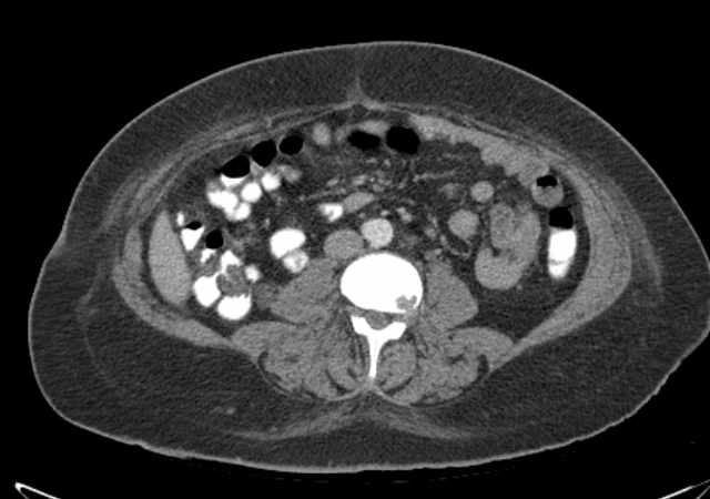 Brown tumors compressing the spinal cord (Radiopaedia 68442-77988 E 68).jpg