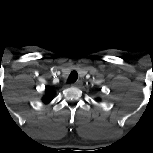 Buccal fat pad arteriovenous malformation (Radiopaedia 70936-81144 A 95).jpg