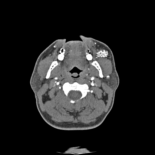Buccal fat pad arteriovenous malformation (Radiopaedia 70936-81144 D 188).jpg