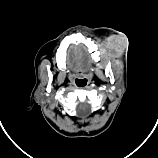 File:Buccal squamous cell carcinoma (Radiopaedia 8520-9346 A 14).jpg