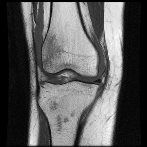 File:Bucket handle meniscus tear (Radiopaedia 56916-63751 Coronal T1 8).jpg
