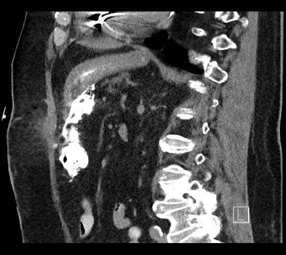 Buried bumper syndrome - gastrostomy tube (Radiopaedia 63843-72577 Sagittal Inject 50).jpg