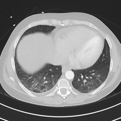Burkitt lymphoma (Radiopaedia 34686-36121 Axial lung window 35).png