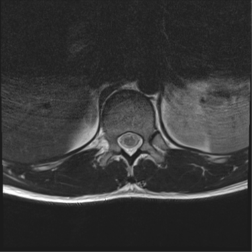 File:Burst fracture - T12 with conus compression (Radiopaedia 56825-63646 Axial T2 22).png