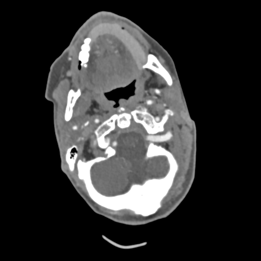 C2 fracture with vertebral artery dissection (Radiopaedia 37378-39200 A 178).png