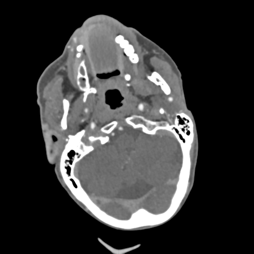 C2 fracture with vertebral artery dissection (Radiopaedia 37378-39200 A 193).png