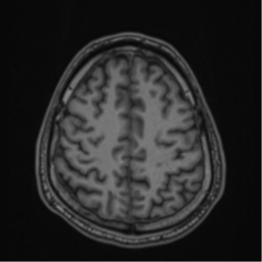 CNS vasculitis (Radiopaedia 55715-62263 Axial T1 73).png