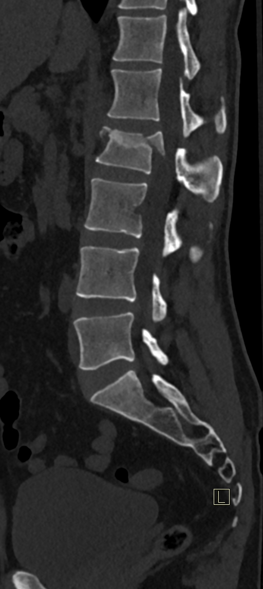 Calcaneal fractures with associated L2 burst fracture (Radiopaedia 71671-82493 Sagittal bone window 37).jpg