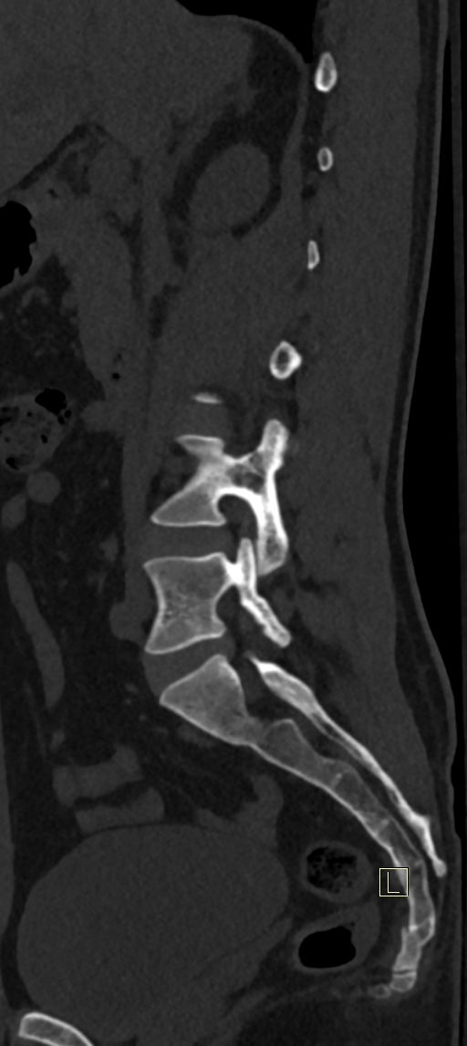 Calcaneal fractures with associated L2 burst fracture (Radiopaedia 71671-82493 Sagittal bone window 54).jpg