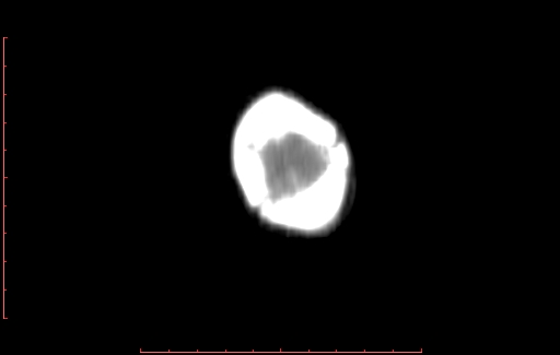 Calcified cephalohematoma (Radiopaedia 78775-91629 Coronal non-contrast 100).jpg