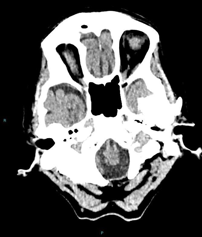 Calcified cerebral emboli from left ventricular thrombus (Radiopaedia 84420-99758 Axial non-contrast 78).jpg