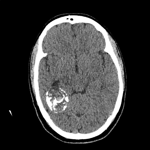 Calcified cerebral hydatid cyst (Radiopaedia 65603-74717 Axial non-contrast 28).jpg
