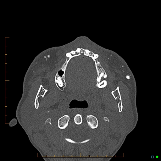 Calcified facial augmentation fillers (Radiopaedia 79514-92679 Axial bone window 80).jpg