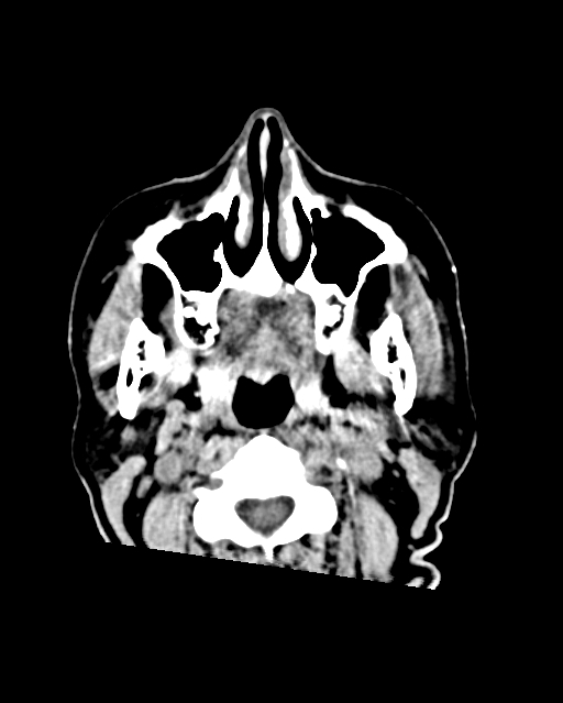 Calcified meningioma (Radiopaedia 74361-85243 Axial non-contrast 60).jpg