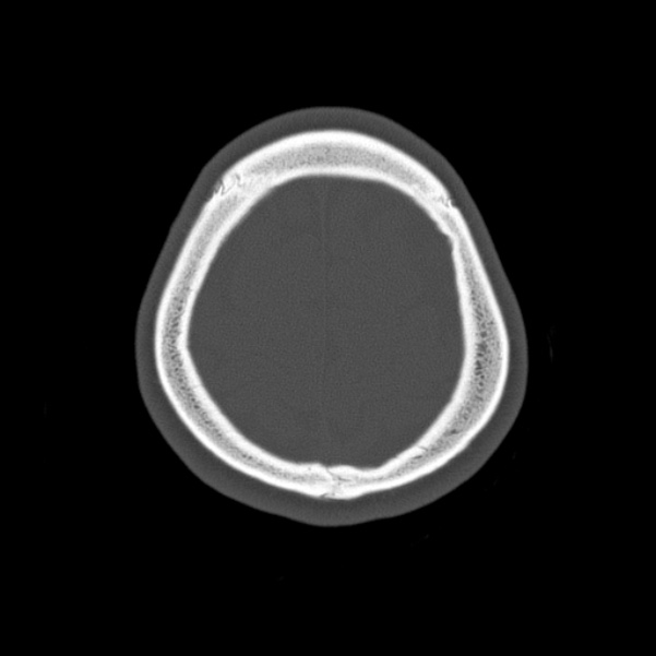 Calvarial osteoma (Radiopaedia 36520-38079 Axial bone window 93).jpg