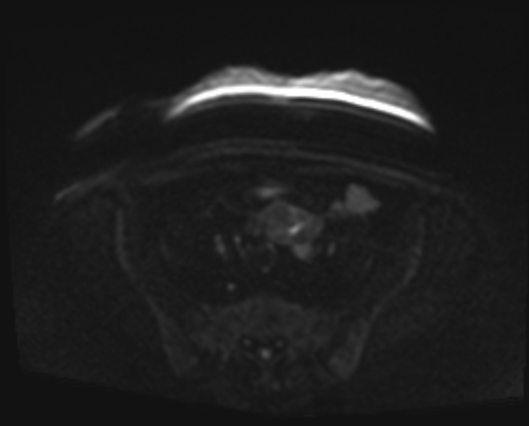 Cancer cervix - stage IIb (Radiopaedia 75411-86615 Axial DWI 53).jpg