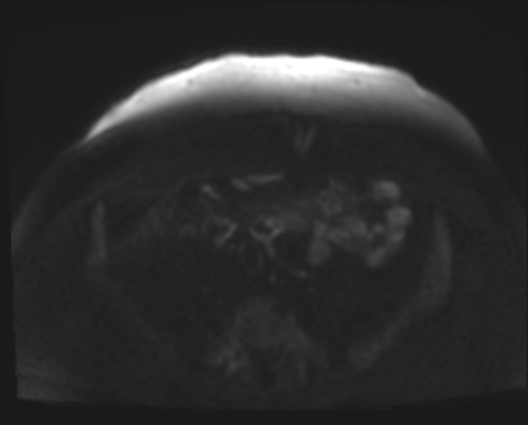 Cancer cervix - stage IIb (Radiopaedia 75411-86615 Axial DWI 87).jpg