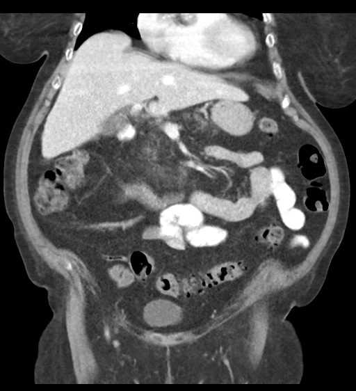Cannonball metastases from endometrial cancer (Radiopaedia 42003-45031 F 29).png