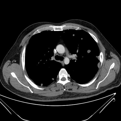 File:Cannonball pulmonary metastases (Radiopaedia 67684-77101 D 104).jpg