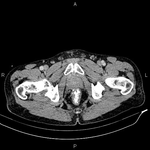 Caput medusae sign - portal hypertension (Radiopaedia 64007-72759 A 103).jpg