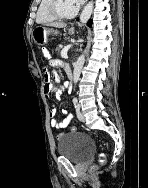 Caput medusae sign - portal hypertension (Radiopaedia 64007-72759 B 47).jpg
