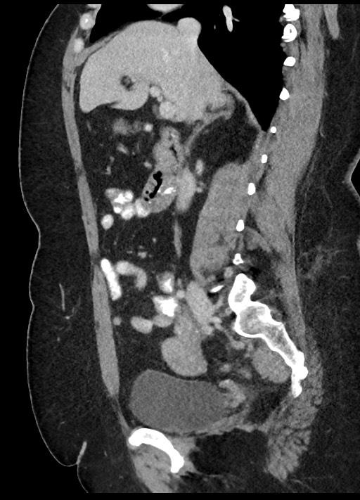 Carcinoid tumor - terminal ileum (Radiopaedia 60931-68739 C 59).jpg