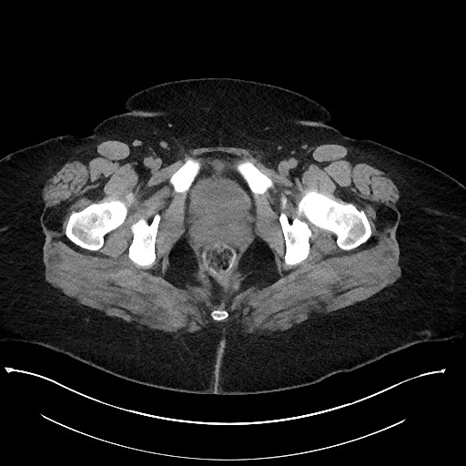 File:Carcinoid tumor - terminal ileum (Radiopaedia 60931-68740 Axial non-contrast 125).jpg