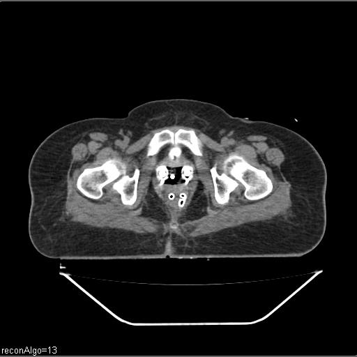 Carcinoma cervix- brachytherapy applicator (Radiopaedia 33135-34173 Axial non-contrast 40).jpg