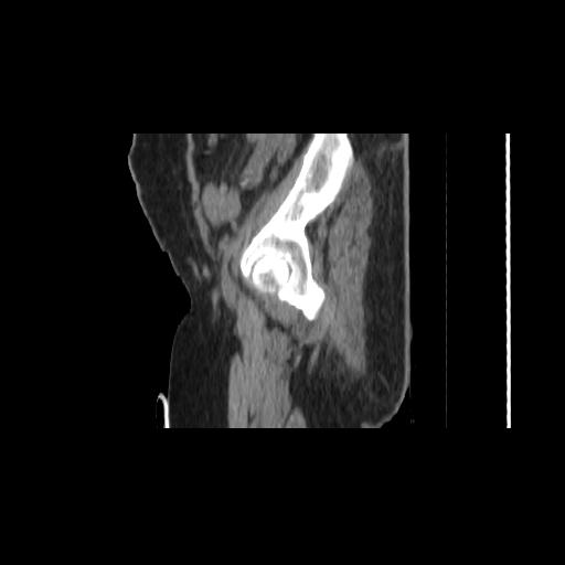 File:Carcinoma cervix- brachytherapy applicator (Radiopaedia 33135-34173 D 18).jpg