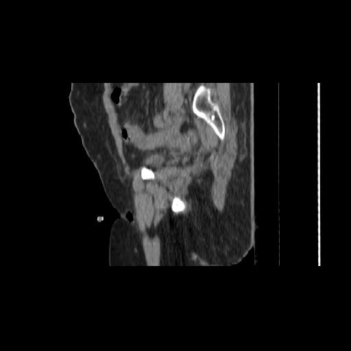 Carcinoma cervix- brachytherapy applicator (Radiopaedia 33135-34173 D 50).jpg