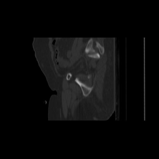 Carcinoma cervix- brachytherapy applicator (Radiopaedia 33135-34173 Sagittal bone window 38).jpg