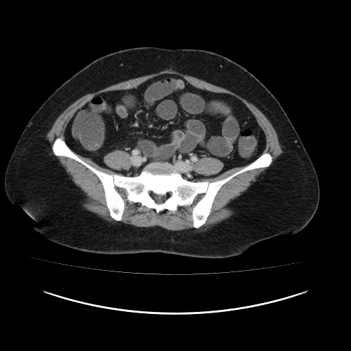Carcinoma colon - hepatic flexure (Radiopaedia 19461-19493 A 91).jpg