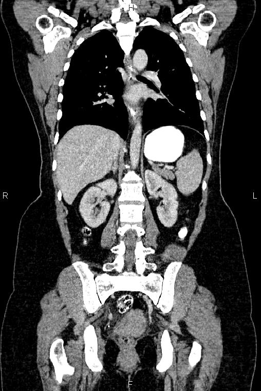 Carcinoma of uterine cervix (Radiopaedia 85861-101700 C 37).jpg