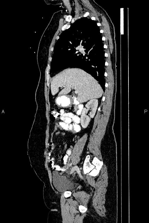 Carcinoma of uterine cervix (Radiopaedia 85861-101700 D 26).jpg