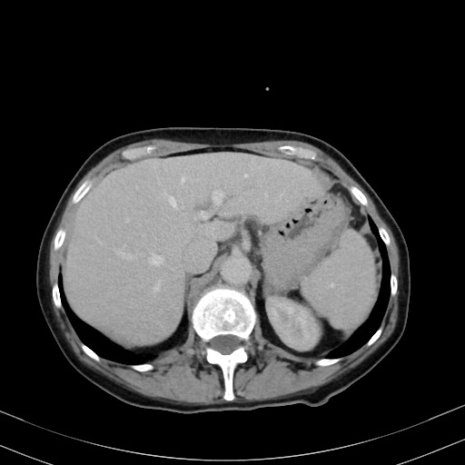 Carcinosarcoma (Radiopaedia 70401-80503 A 14).jpg