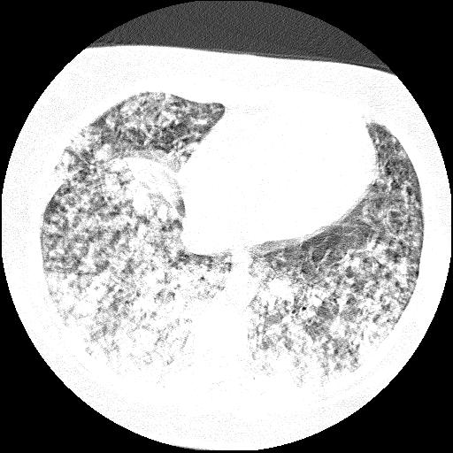 Cardiac angiosarcoma (Radiopaedia 66010-75181 Axial lung window 26).jpg