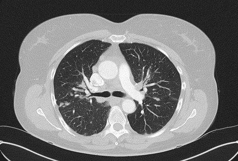 File:Cardiac sarcoidosis (Radiopaedia 74548-85534 Axial lung window 33).jpg
