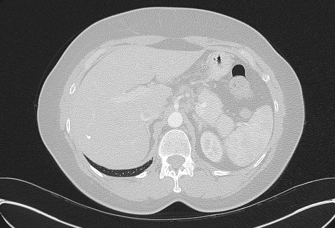 File:Cardiac sarcoidosis (Radiopaedia 74548-85534 Axial lung window 92).jpg