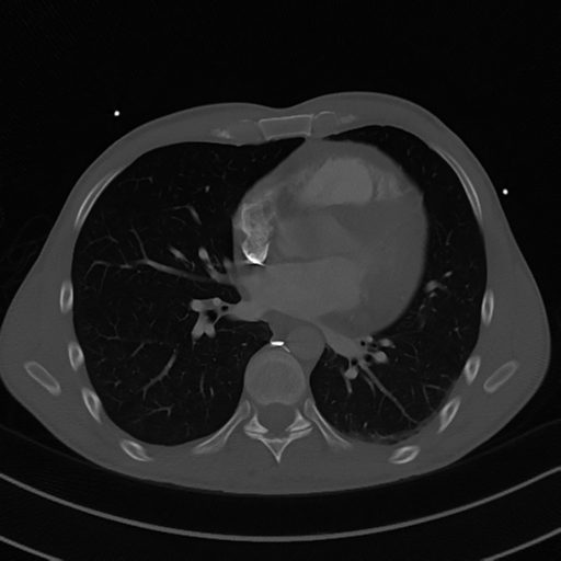 Cardiac tumor - undifferentiated pleomorphic sarcoma (Radiopaedia 45844-50134 Axial bone window 39).png