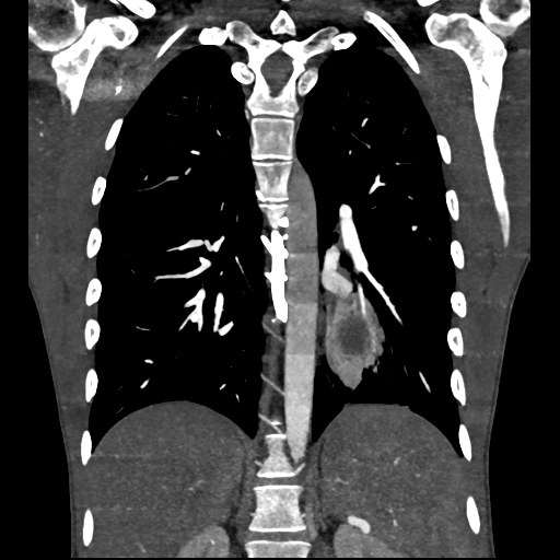File:Cardiac tumor - undifferentiated pleomorphic sarcoma (Radiopaedia 45844-50134 Coronal non-contrast 47).png