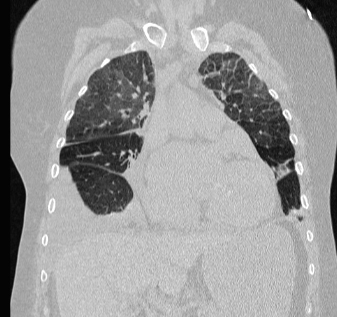 Cardiogenic pulmonary edema (Radiopaedia 29213-29609 Coronal lung window 25).jpg