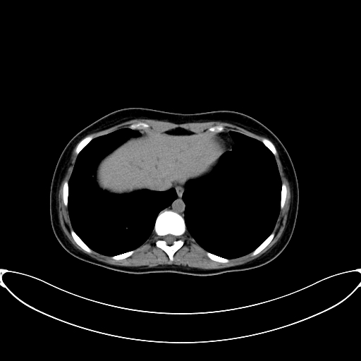 Caroli disease with medullary sponge kidney (Radiopaedia 82622-96804 Axial non-contrast 12).jpg