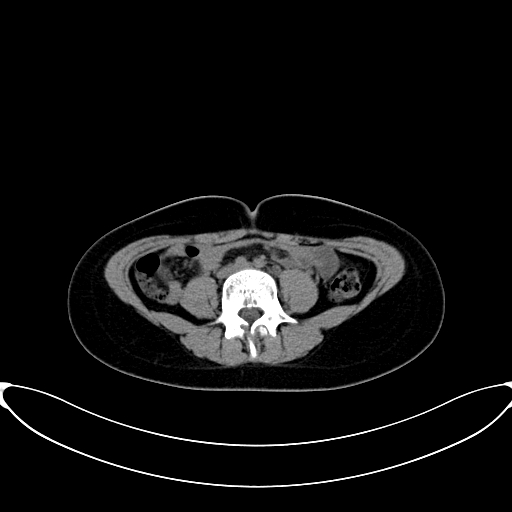 Caroli disease with medullary sponge kidney (Radiopaedia 82622-96804 Axial non-contrast 45).jpg