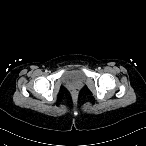 Caroli disease with medullary sponge kidney (Radiopaedia 82622-96804 C 75).jpg
