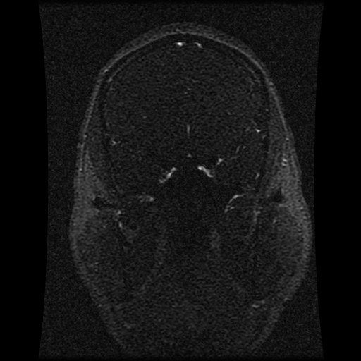 Carotid arterial dissection with acute cerebral infarction (Radiopaedia 26636-26784 MRV 113).jpg