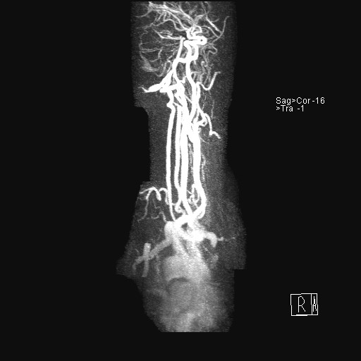File:Carotid artery dissection (Radiopaedia 28441-28689 MIP Carotids MRA 13).jpg