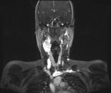 Carotid body tumor (Radiopaedia 12777-12912 MRA 30).jpg