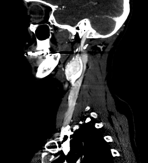 File:Carotid body tumor (Radiopaedia 39845-42300 D 20).jpg