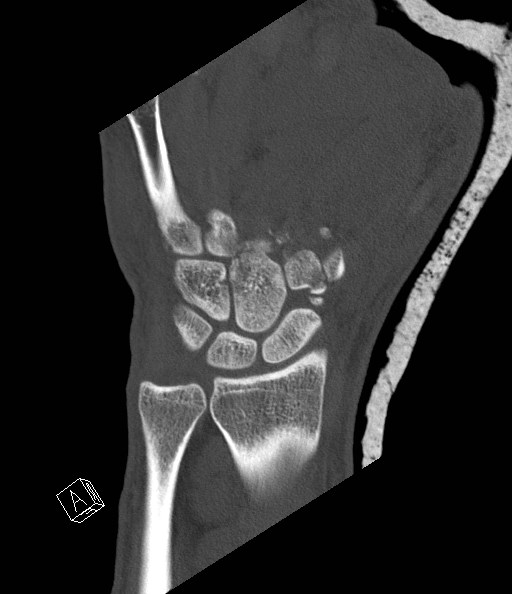 File:Carpal fractures (smart watch impaction) (Radiopaedia 55844-62430 Coronal bone window 11).jpg